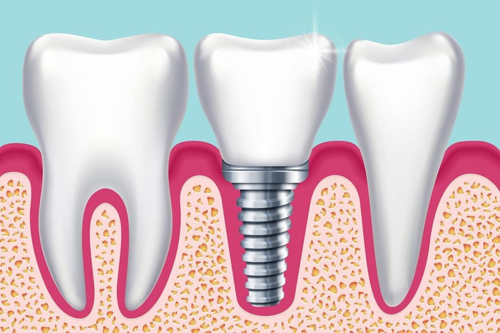 Dental-Implants-Kellyville-Ridge-Should-You-Shop-Around