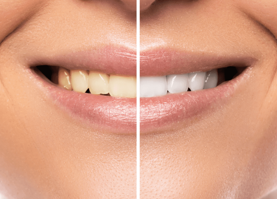 Why choose teeth whitening at the dentist?