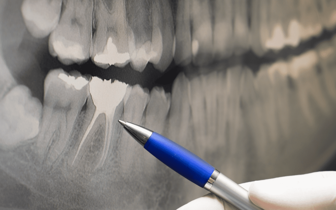 Why Are Dental X-rays Important?