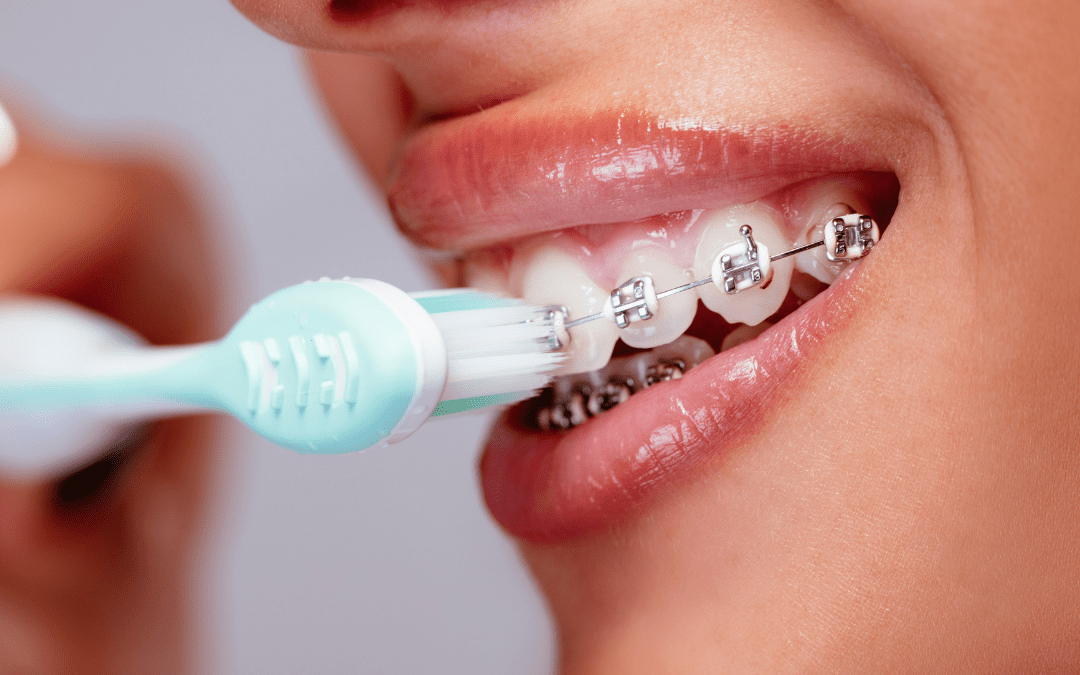 Helpful Tips for Braces