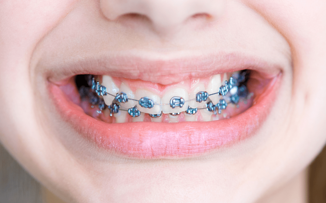 braces- blog