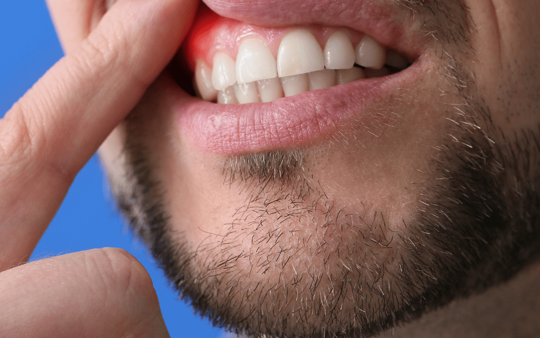 Common Misconceptions About Gum Disease