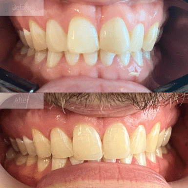 invisalign and composite veneers