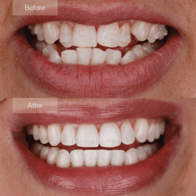 invisalign