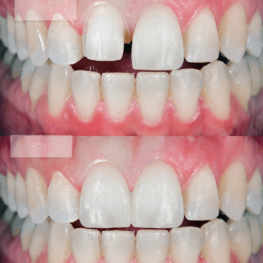 Single porcelain veneer