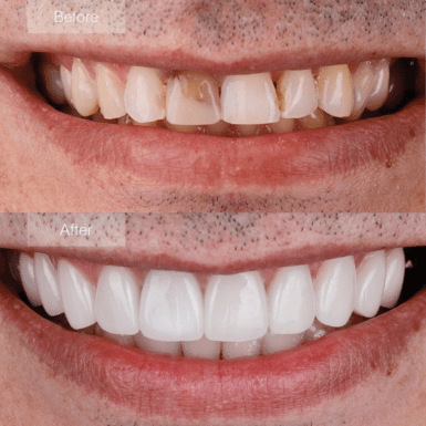 Smile makeover with porcelain veneers