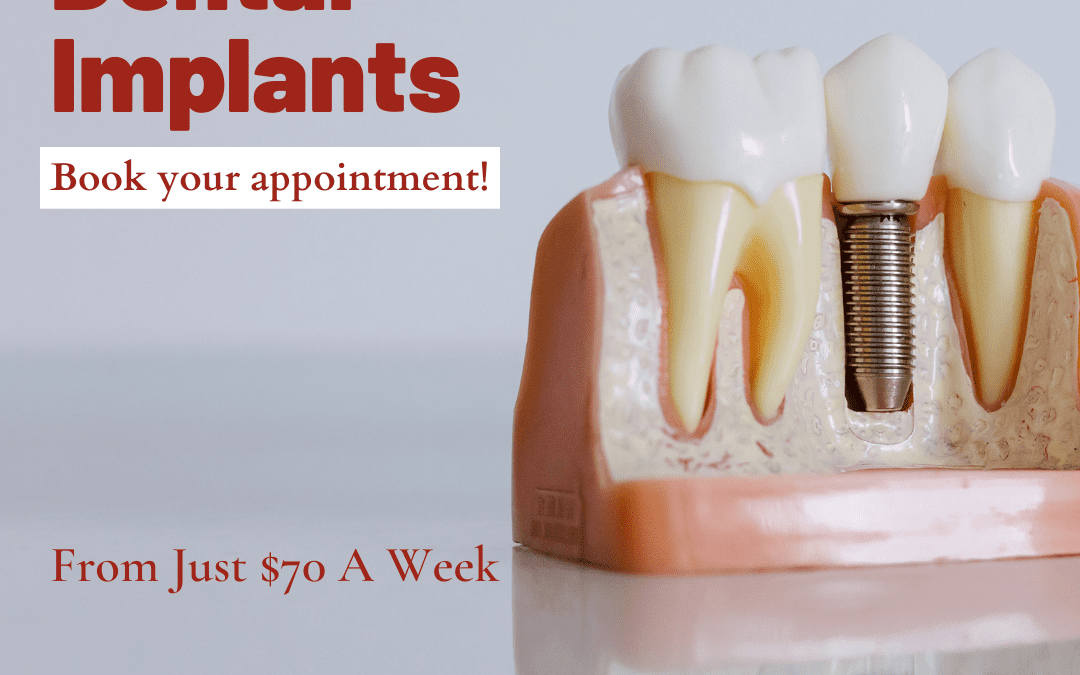 dental implants for just $70 a week