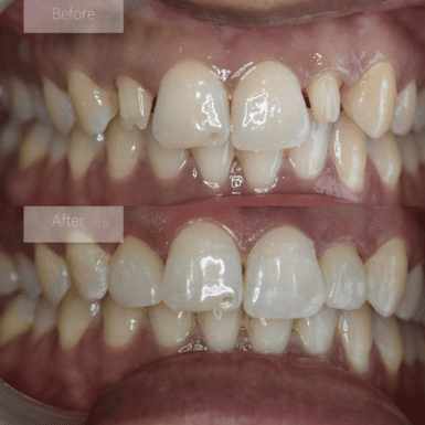 2 porcelain crowns