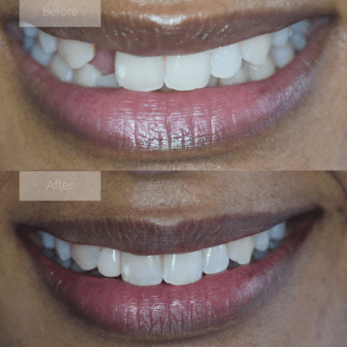 smile makeover, bridges