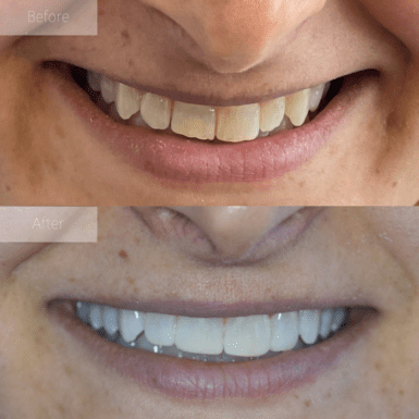 composite veneers before and after