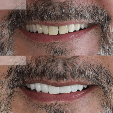 porcelain veneers before and after