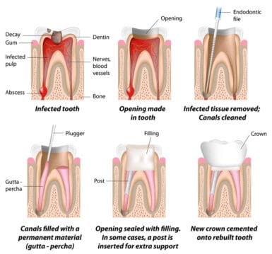 Root Canal Treatment. Tallawong, Riverstone, Beaumont Hills